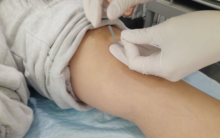함소아한의원 해운대점 폐·기관지 관리: 아이 팔에 침 치료를 진행하는 근접 장면